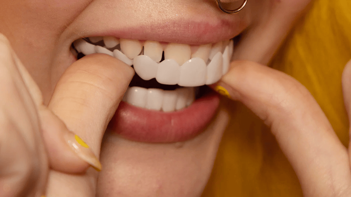 Sofortige Lächelverwandlung mit Snap on Smile Veneers