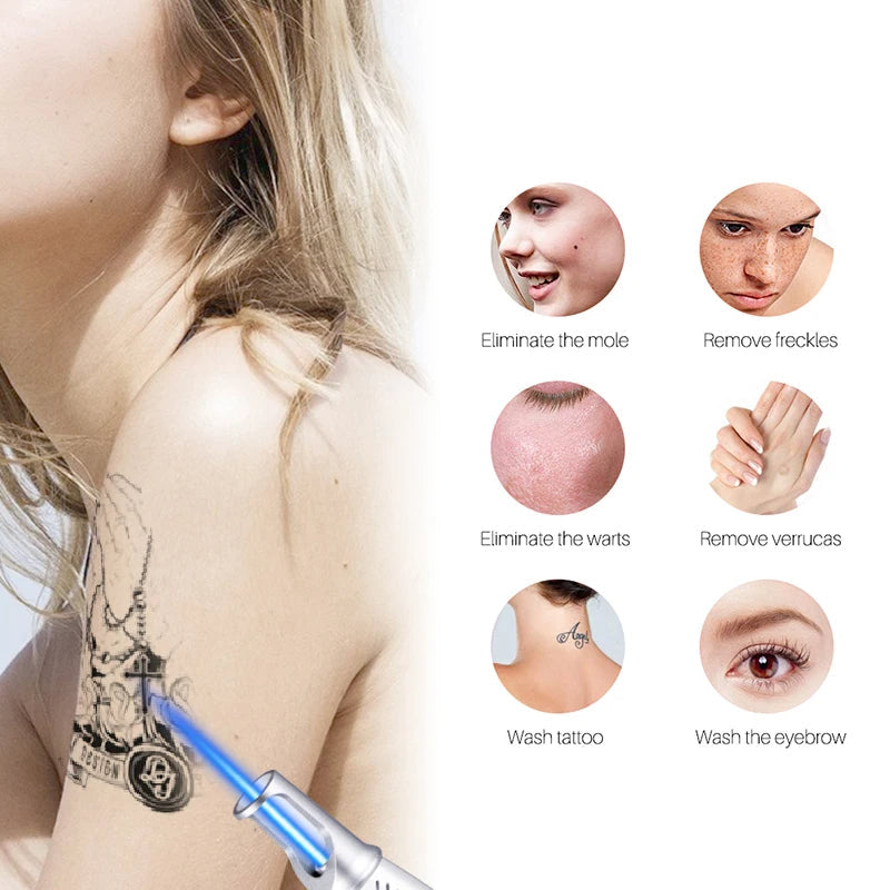 Smart Tattoo-Entfernungslaserstift - Entfernen Sie Muttermale, Sommersprossen, Akne, Tattoos