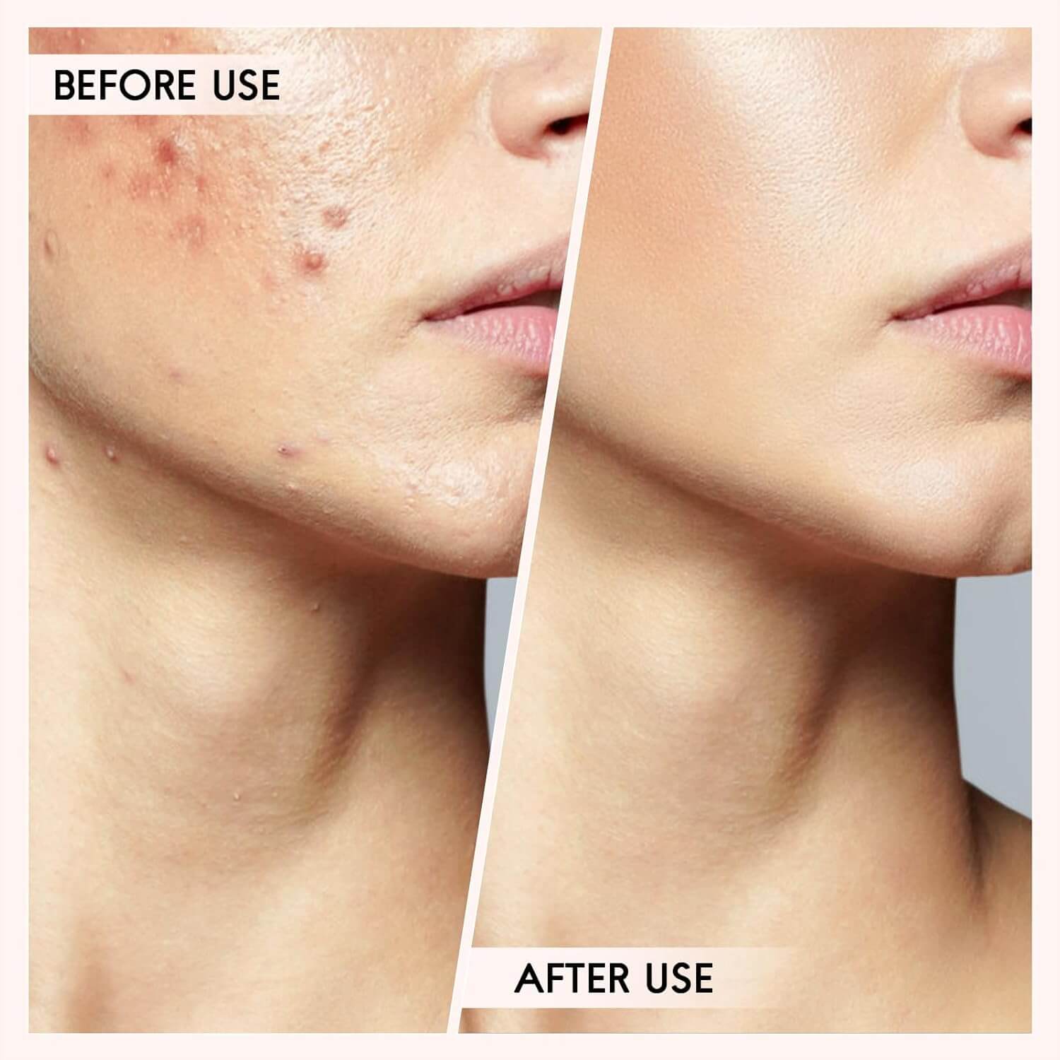 Mitesser Entferner Set Pickel Ausreinigen Werkzeug