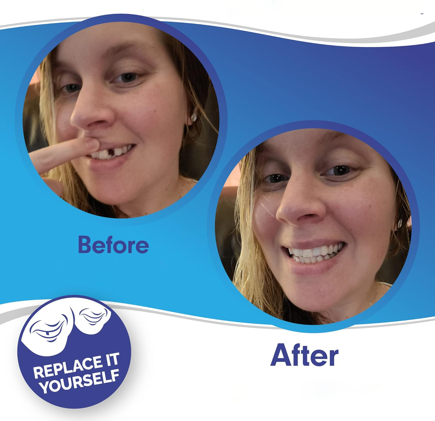 Smile Veneer (Oben & Unten Inklusive)