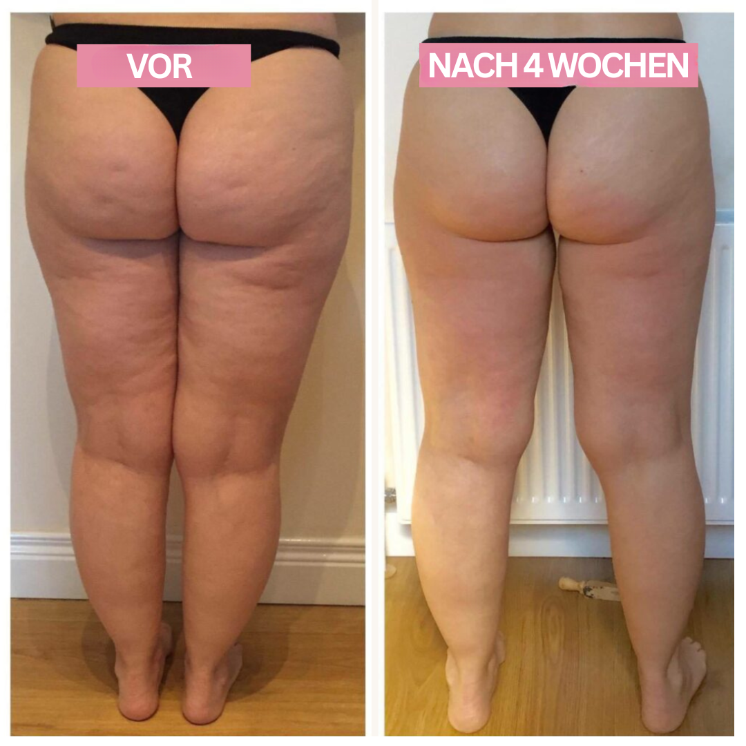 Anti-Cellulite-Cupping-Gerät - Effiziente Hautstraffung