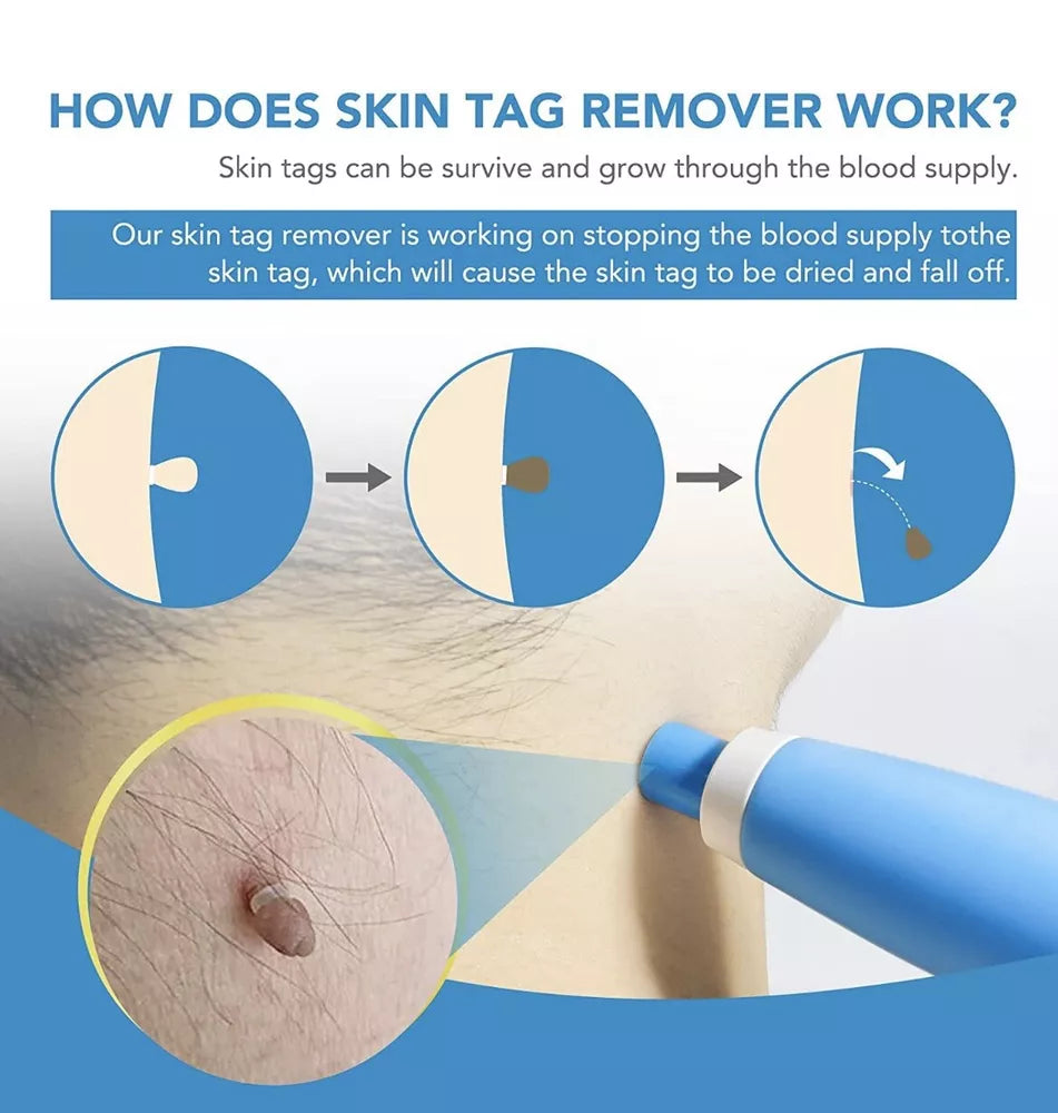 Hautwarzenentfernungskit – Schnelle, einfache und nicht irritierende Behandlung für glatte Haut