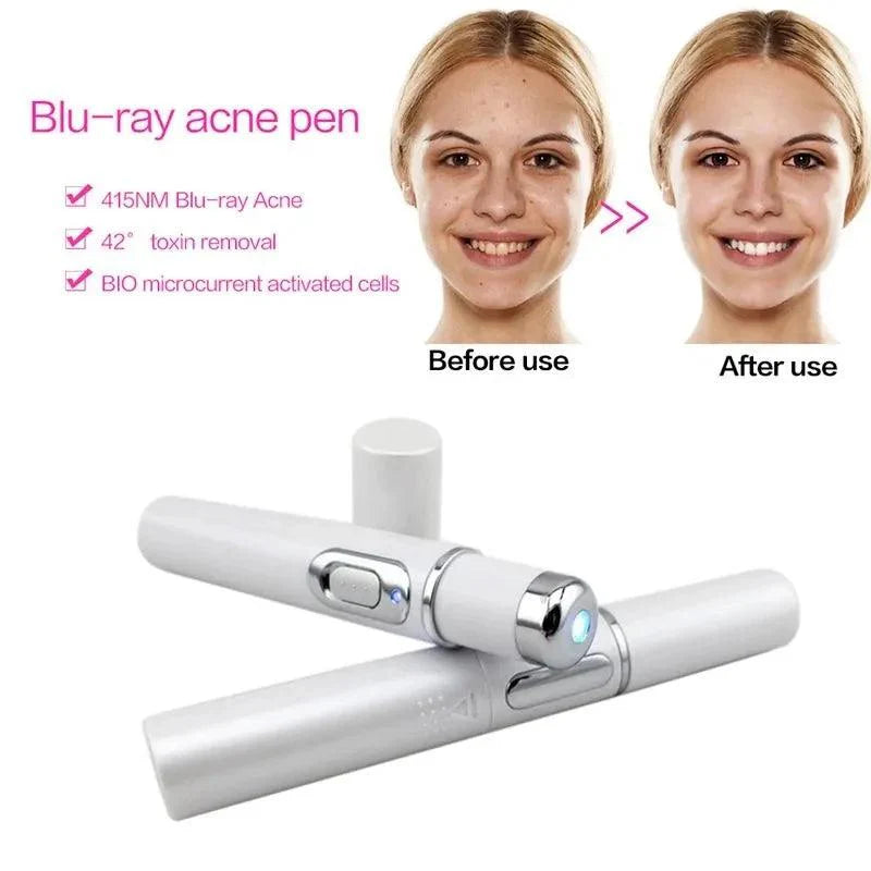Blaues Licht Gesichtsgerät Akne Faltenentfernung Laserstift Hautfleckenentfernung Anti Krampfadern Besenreiser Radiergummi Medizinische Behandlung