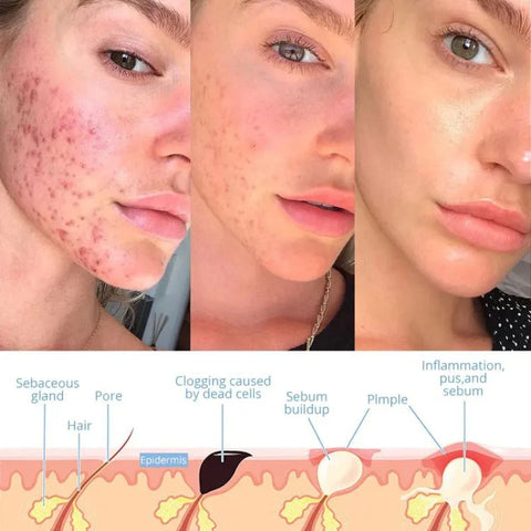 Professioneller Hochfrequenz-Gesichtsstaub – Anti-Aging & Hautverjüngung