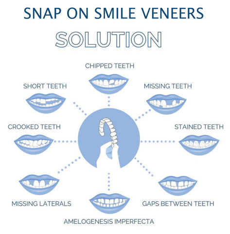 Smile Veneer (Oben & Unten Inklusive)