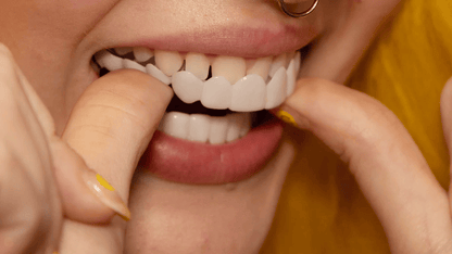 Sofortige Lächelverwandlung mit Snap on Smile Veneers
