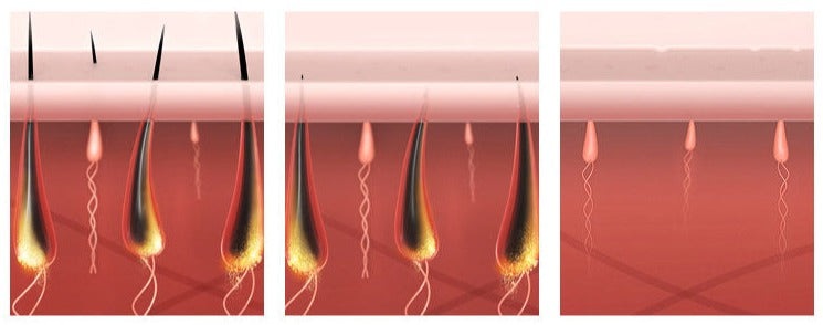 Zelara IPL Laser Haarentfernung