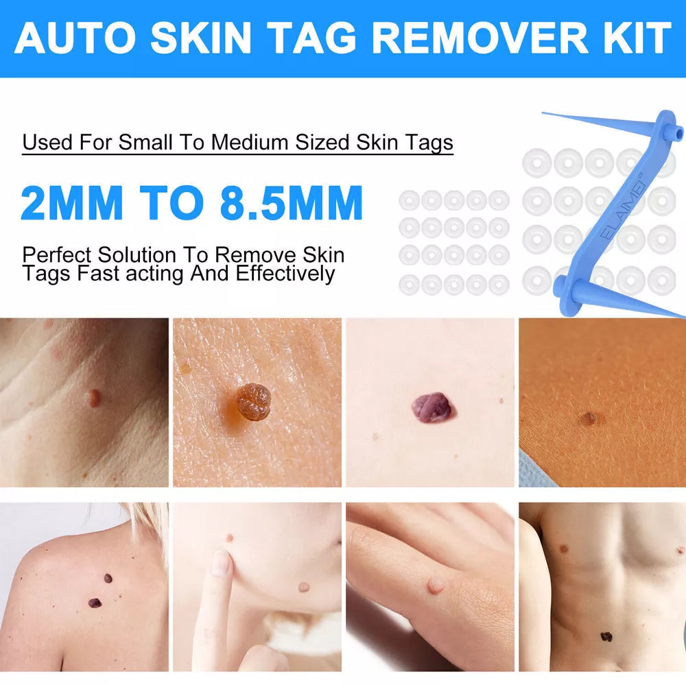 Hautwarzenentfernungskit – Schnelle, einfache und nicht irritierende Behandlung für glatte Haut