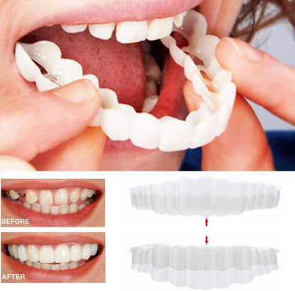 Smile Veneer (Oben &amp; Unten Inklusive)