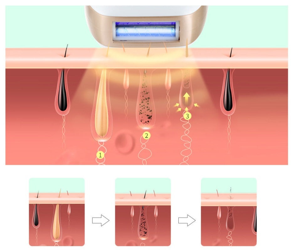 Zelara IPL Laser-Haarentfernung Gerät