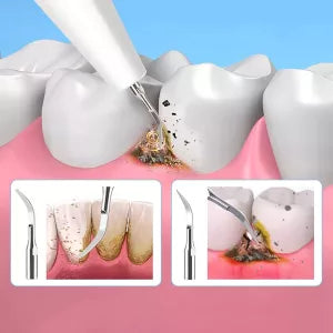 Elektrischer Zahnsteinentferner