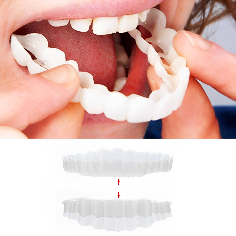 Smile Veneer (Oben &amp; Unten Inklusive)