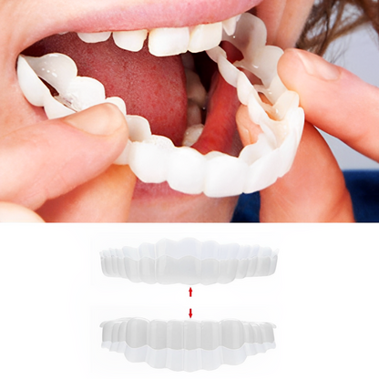 Smile Veneer (Oben &amp; Unten Inklusive)