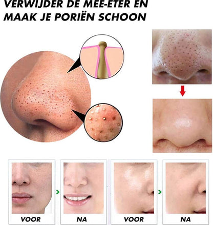 Elektrischer Porenreiniger für reine Haut