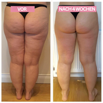 Anti-Cellulite-Cupping-Gerät - Effiziente Hautstraffung