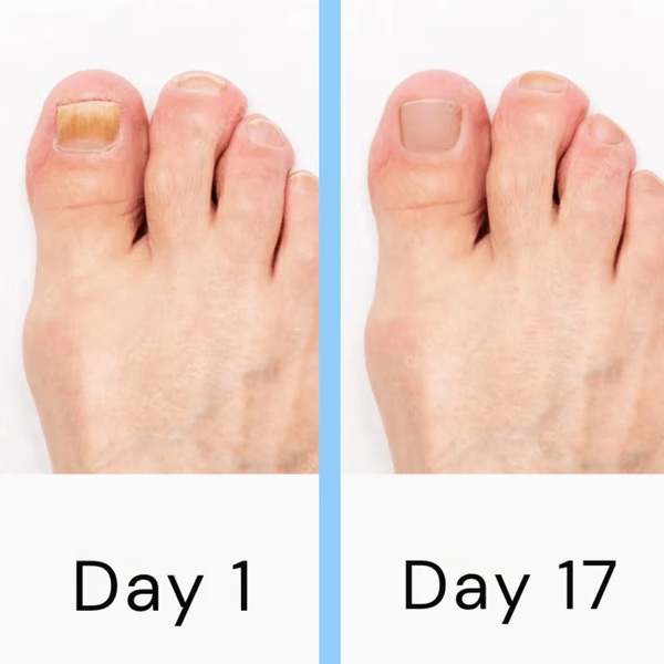 Nagelpilz-Lasergerät mit dualen LED-Wellenlängen, schmerzfreier Behandlung, tragbar, für gesunde Nägel