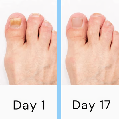 Nagelpilz-Lasergerät mit dualen LED-Wellenlängen, schmerzfreier Behandlung, tragbar, für gesunde Nägel