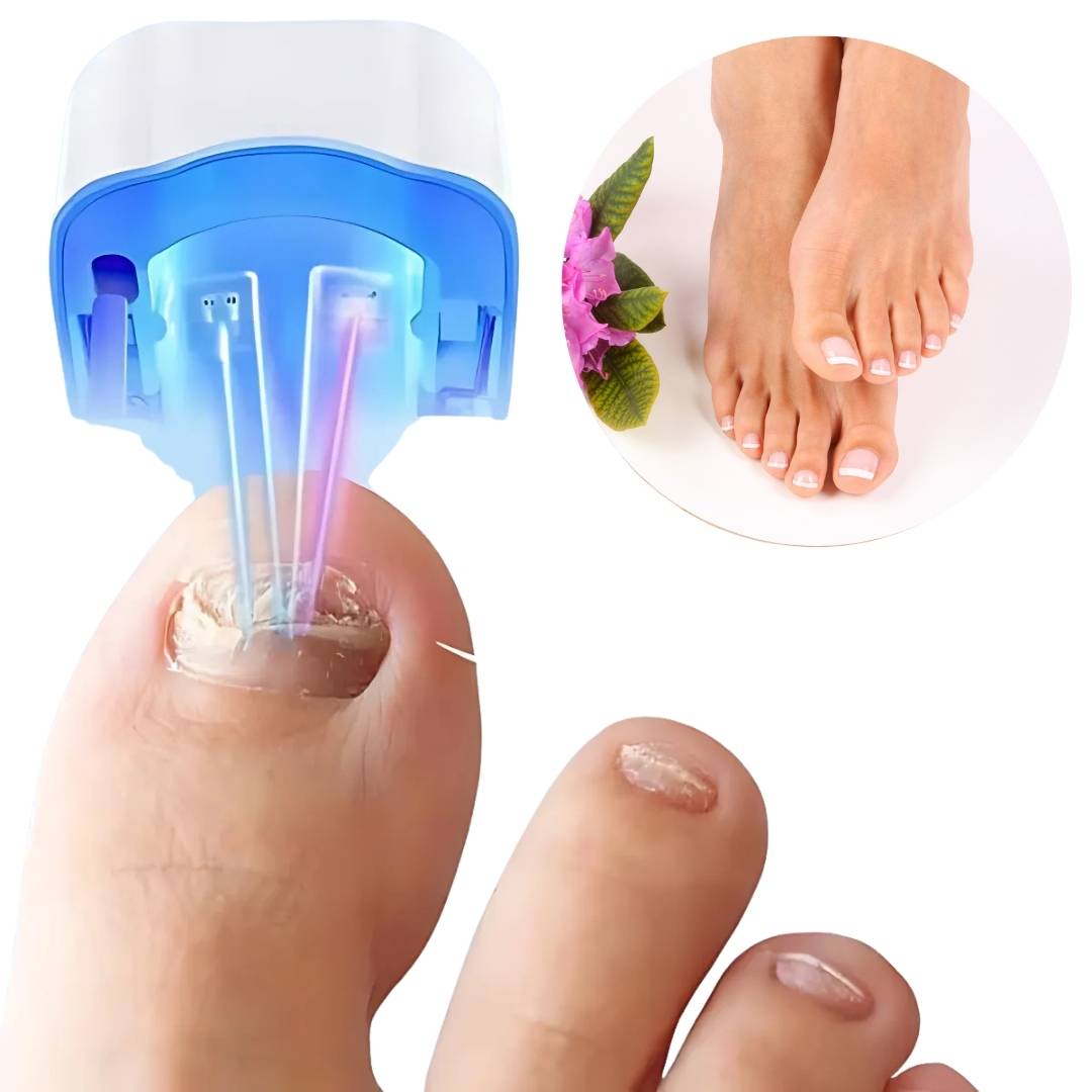 Nagelpilz-Lasergerät - Schmerzfreie Behandlung