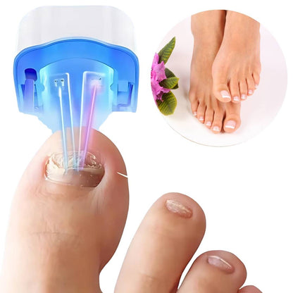 Nagelpilz-Lasergerät - Schmerzfreie Behandlung