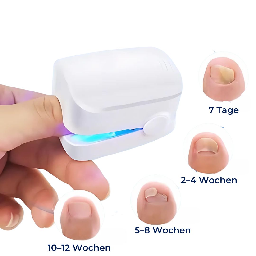 Nagelpilz-Lasergerät - Schmerzfreie Behandlung