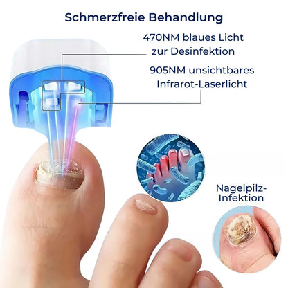 Nagelpilz-Lasergerät - Schmerzfreie Behandlung
