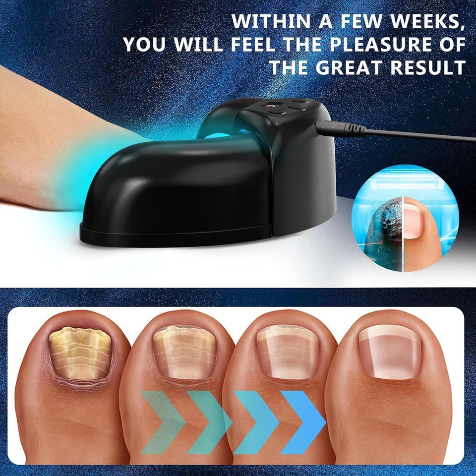Nagelpilzlaser