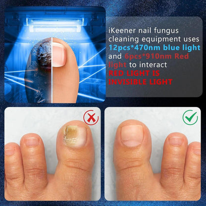 Nagelpilzlaser