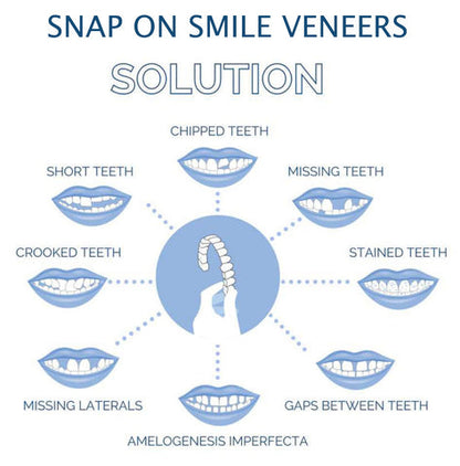 Smile Veneer (Oben &amp; Unten Inklusive)